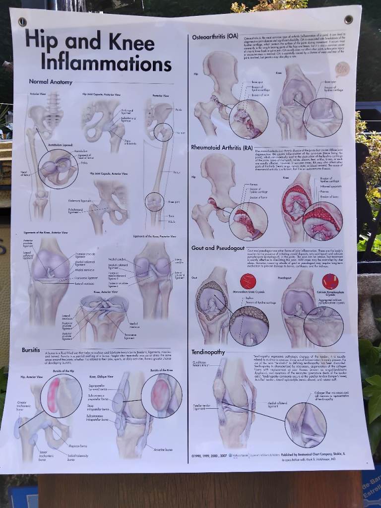 HIP and KNEE INFLAMMATIONS MEDICAL PLASTIC WALL CHART