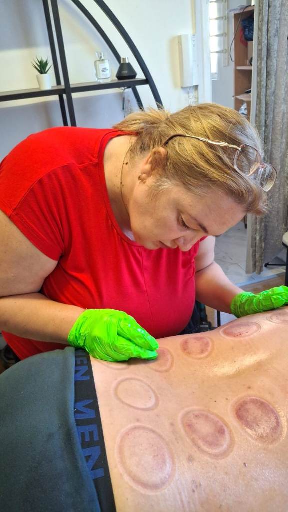 Hands-on-Hand Hijama Cupping Course | Practical Wet Cupping Training