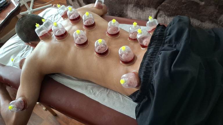 Enroll Hijama Cupping Training in D2d Therapies