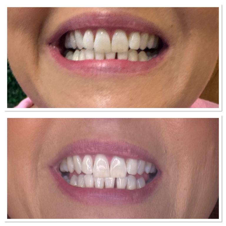 Cosmetic teeth whitening 