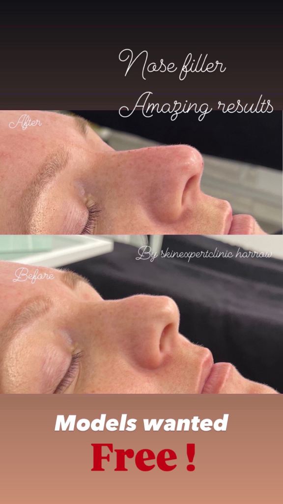 Models wanted for nose fillers free 