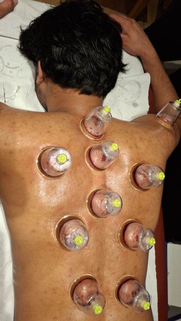 Hijama Cupping Therapy Course: From Ancient Healing to Modern Practice
