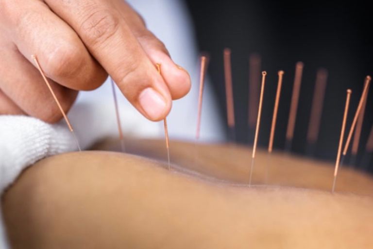 Acupuncture for Pain Relief - In Clinic or in your Home. 