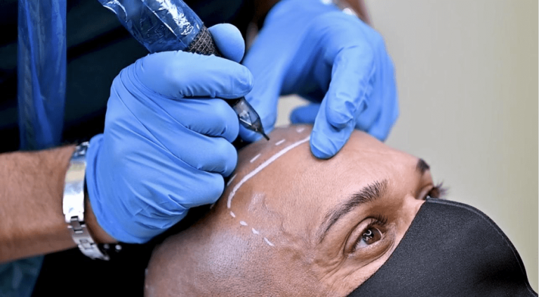 SMP Scalp Micro Pigmentation Clinic 