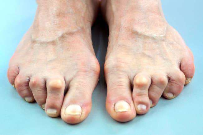 ONE STOP FOOT TREATMENT SERVICES BY QUALIFIED FHP - £35/treatment
