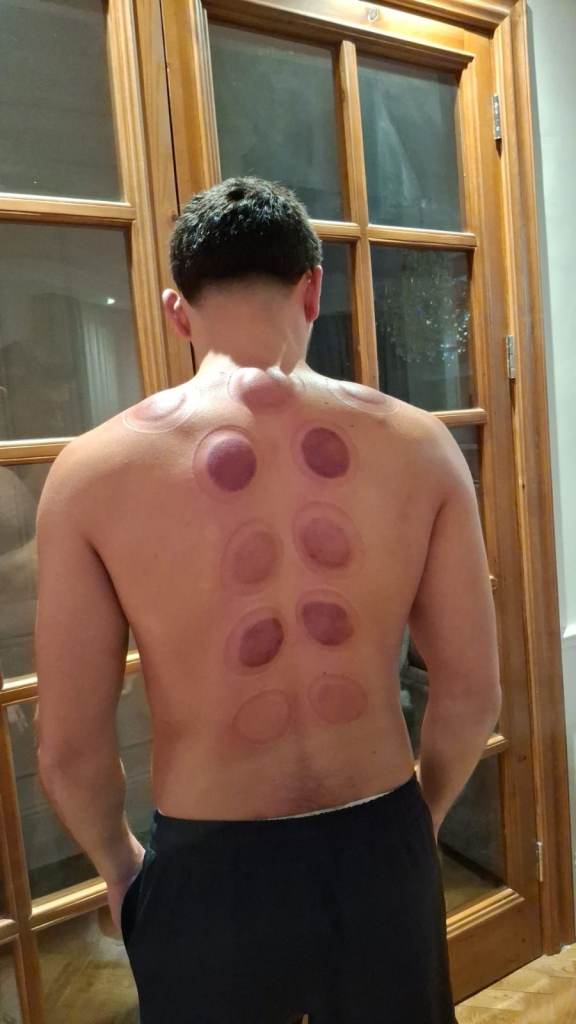 Hijama & Cupping Therapy Certification Course | Beginner to Advanced