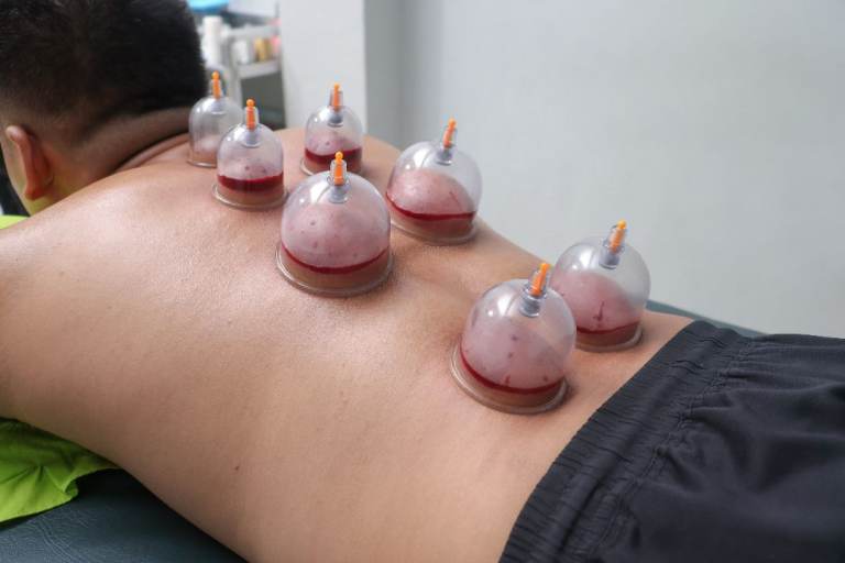 Hijama-Cupping-Visiting-Mokre stawianie baniek-ventuzoterapie umedă-Redbridge, London