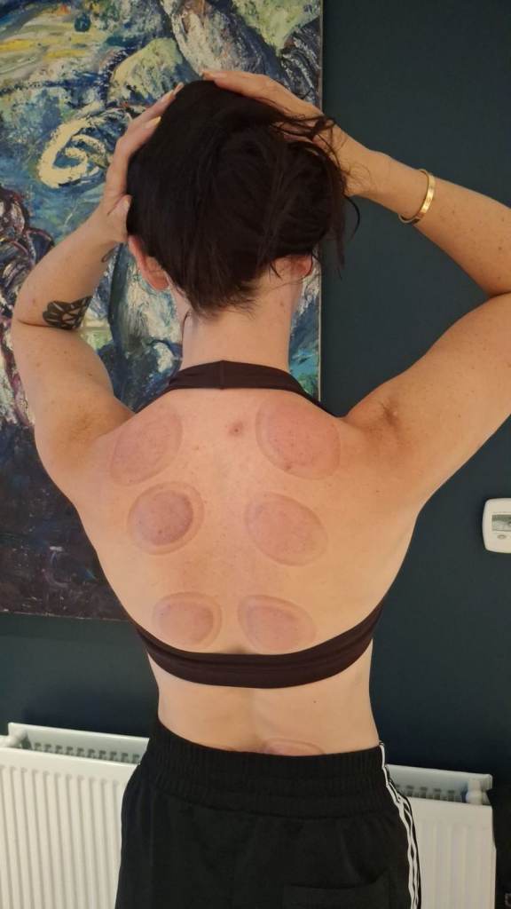 Professional Hijama Cupping Course in London | Certified Practical Training