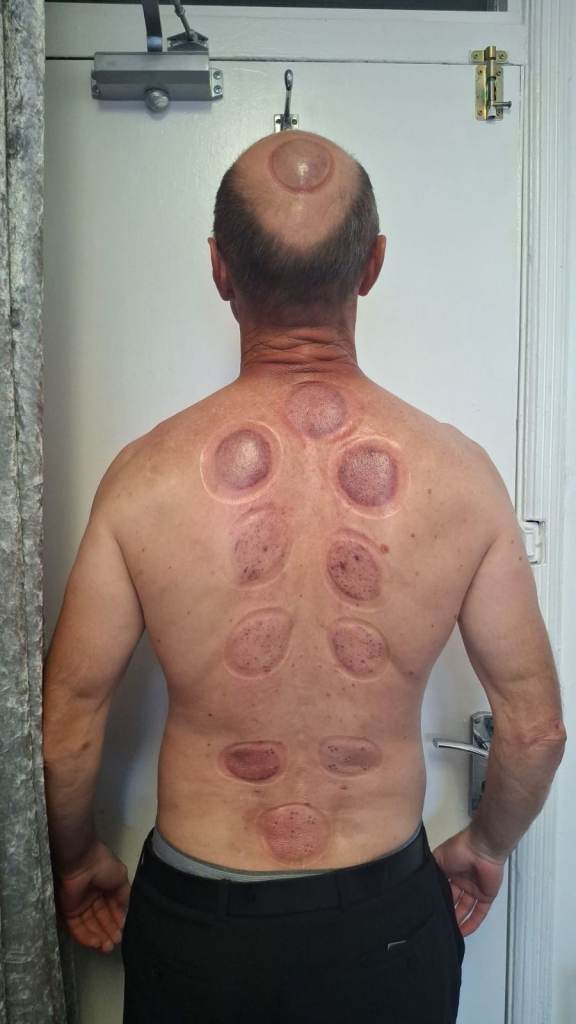 Hijama Cupping Course in London | Practical Training & Certification