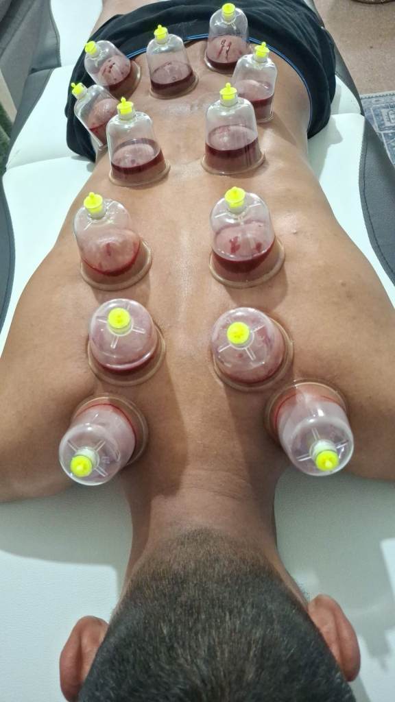 Professional Hijama & Cupping Therapy in London