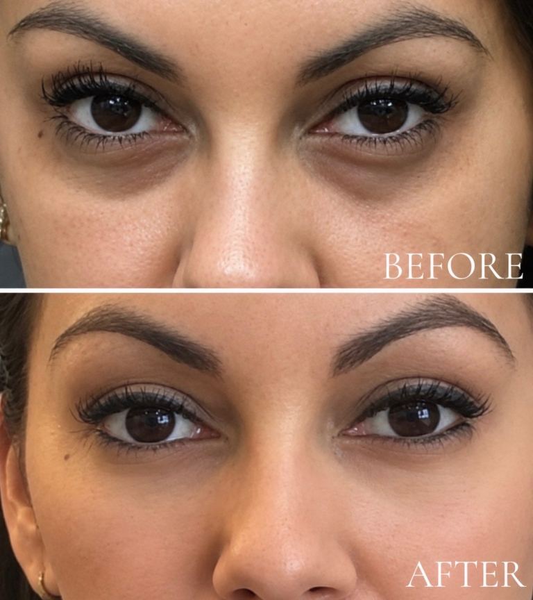 Dark circle eye treatment