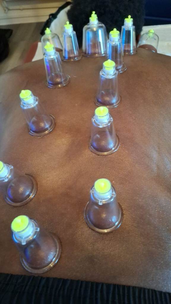 Hijama and Dry Cupping Course in London – Certified Training