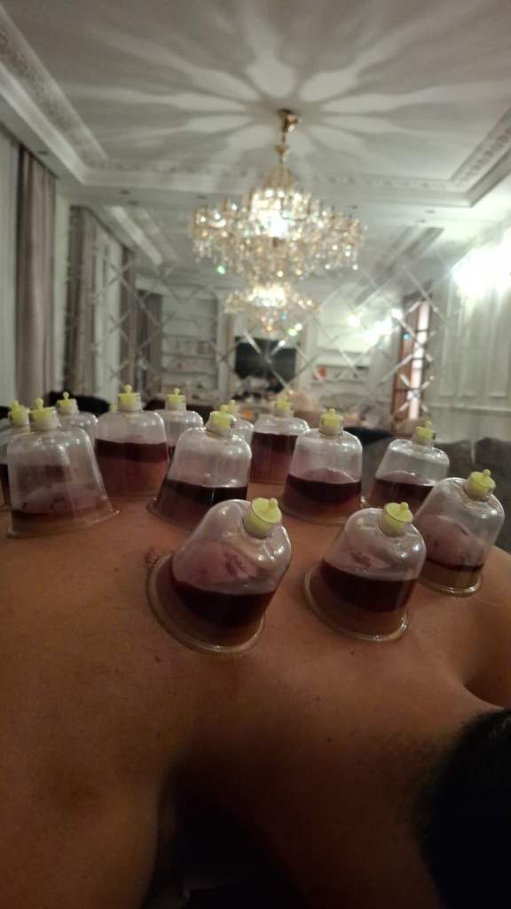 Certified Hijama Practitioner Training (Beginner to Expert)