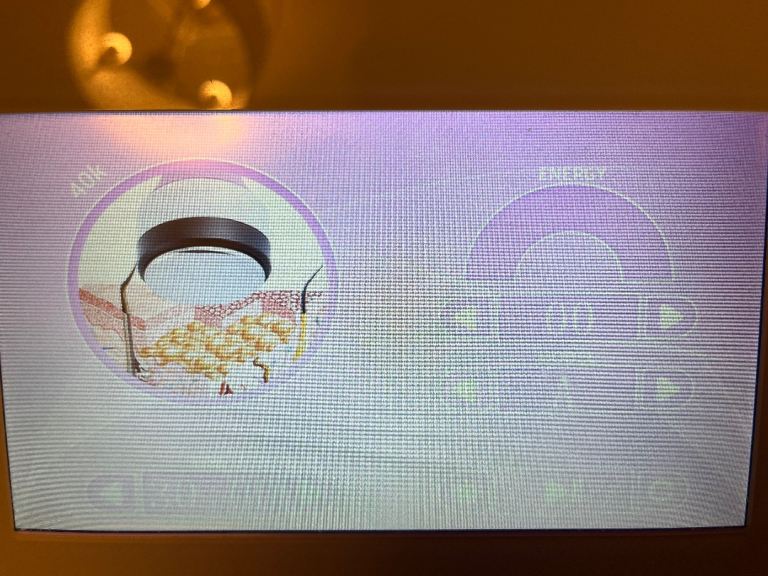 Ultrasonic RF Cavitation machine