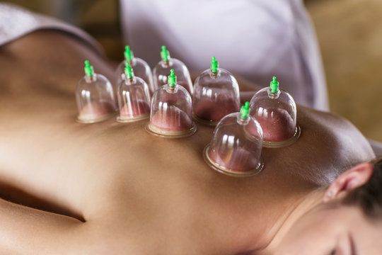 Professional Mobile Hijama Cupping Therapy – 