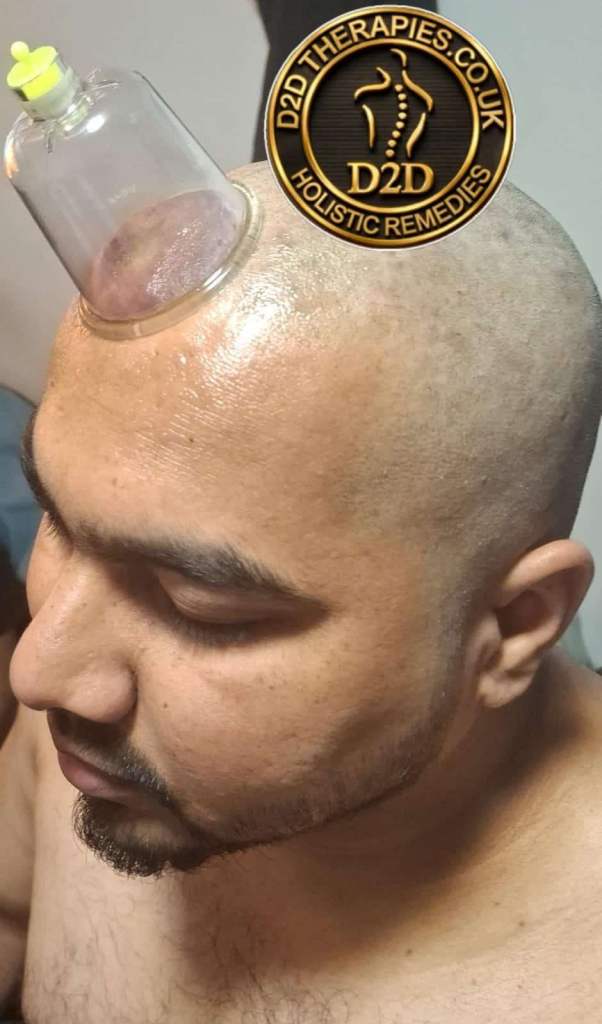 Hijama Cupping Course in London | Practical Wet & Dry Cupping Training