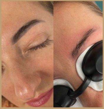 Laser Tattoo Removal (Pico Laser) – East London/essex | First Session £30