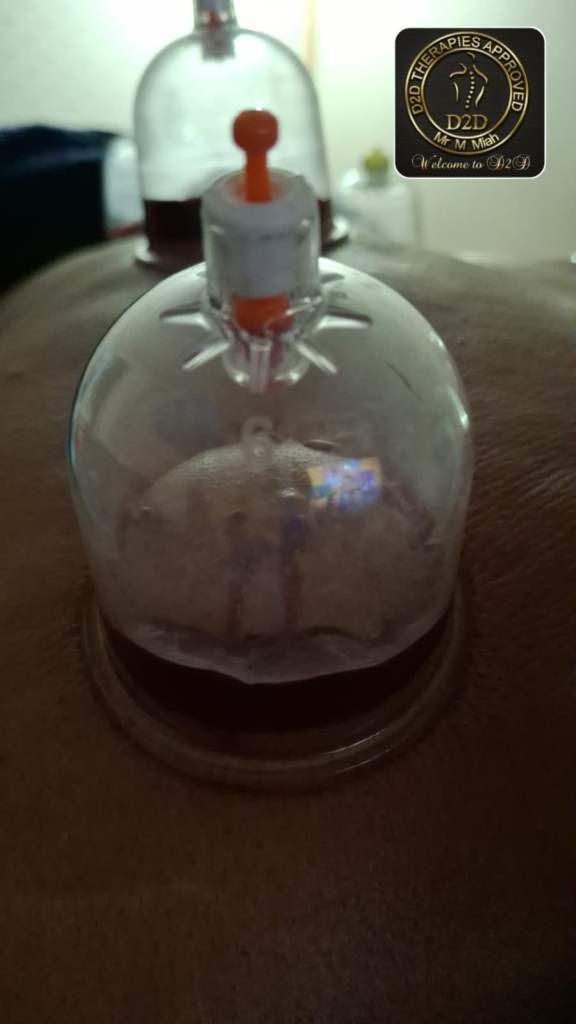 Hijama Cupping Training in London: Become a Certified Practitioner in 2026